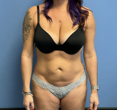 Tummy-Tuck-with-Liposuction--Case-Study-7031 | Before Liposuction